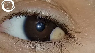 Limbal Dermoid