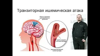 Транзиторная ишемическая атака