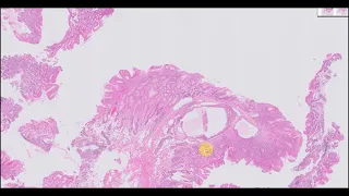 Autoimmune gastritis with hyperplastic polyp