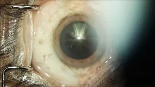 Temopral SICS In black cataract..