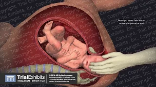 Shoulder Dystocia During Delivery