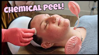 How To Apply Jessner Chemical Peel! DOs and DONTs!