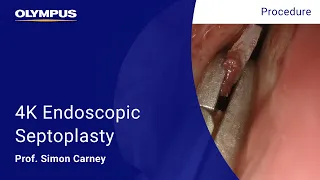 4K Endoscopic Septoplasty - Prof. Simon Carney