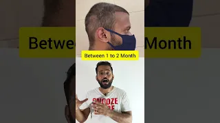 Hair Growth Result After 11 Month Of Hair Transplant Result #short