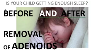 Before and After removal of adenoids   3 year old with sleep apnea and nasal speech