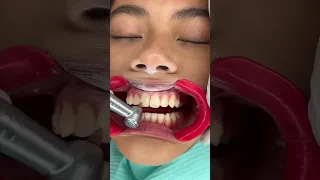 New Year Braces Removal