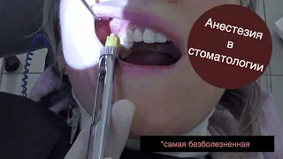 Анестезия в стоматологии. Самая безболезненная ИНФИЛЬТРАЦИОННАЯ анестезия