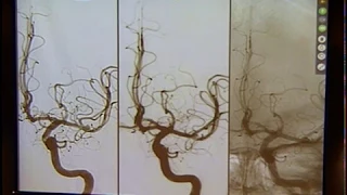 Interventional Neurology 7/18/17