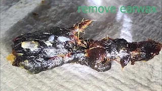 Ear Cleaning Part 60  ear wax removing satisfying everyday