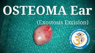 Ear Canal Osteoma Excision HD #Ear_Surgery
