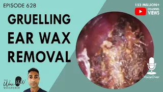 628 - Gruelling Ear Wax Removal