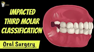 ORAL SURGERY | IMPACTED THIRD MOLAR CLASSIFICATIONS AND DIFFICULTY INDICES