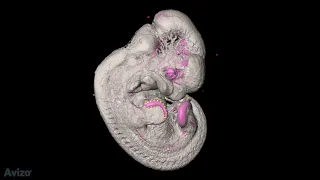 Quantification of gene expression patterns to reveal the origins of abnormal morphogenesis