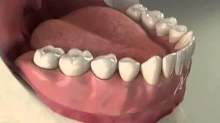 Implants Overdenture Lower Procedure