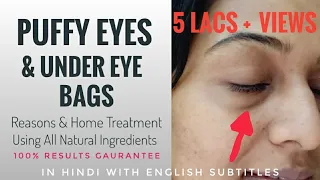 PUFFY EYES & UNDER EYE BAGS - Reasons & Treatment Using Natural Ingredients | 100% Results Gaurantee