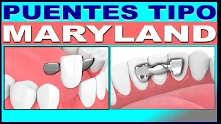 FIXED DENTAL BRIDGES MARYLAND TYPE (OPINION OF AN EXPERT)