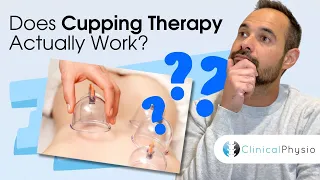 Does Cupping Work? | Expert Physio Review