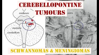 Cerebellopontine Tumours - Schwannomas & Meningiomas