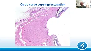 AANP Teaching Rounds - November 28 - The Pathology of Glaucoma