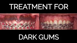 Gum Bleaching Procedure for Black Gums (2018)