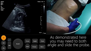 Ultrasound Tutorial: Kidney & Bladder / Urinary Tract | Radiology Nation