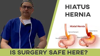 How Safe Is Surgery For Hiatus Hernia Repair?