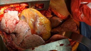 Video2 Thoracotomy