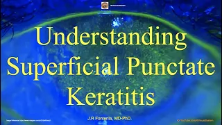 Understanding Superficial Punctate Keratitis.