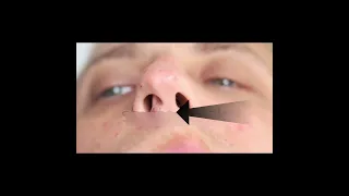 Curvature of nasal septum