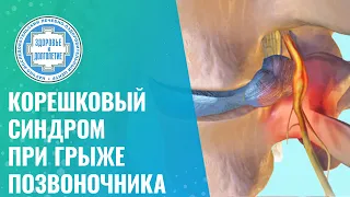 ​🔴​ Корешковый синдром при грыже поясничного отдела позвоночника