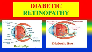 DIABETIC RETINOPATHY - Define ,  causes , pathophysiology , clinical , management