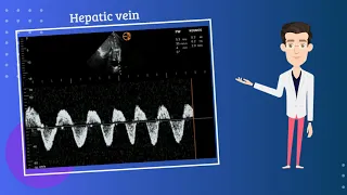 Severe venous congestion on point of care ultrasound | VExUS | POCUS | Dr. Koratala (@NephroP)