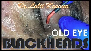 OLD EYE BLACKHEADS REMOVAL BY DR.LALIT KASANA