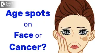 How do you know if age spots on skin are not cancerous? - Dr. Urmila Nischal