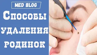 Как удалить родинку? | Хирургические способы удаления невусов на лице и теле | Плюсы и минусы