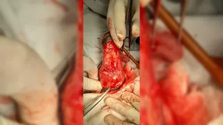 Priapism with fracture penis