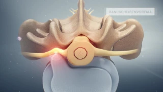 «Rückenschmerzen – Infiltration an der Lendenwirbelsäule» - Schulthess Klinik