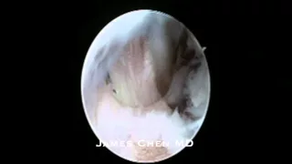 Arthroscopic Elbow Loose Body Removal & Bone Spur Decompression