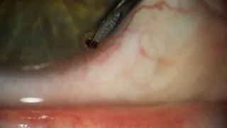 Needle in Eye to remove Metal Foreign Body