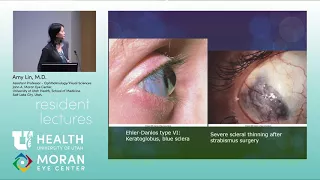 Systemic Disorders with Corneal Changes