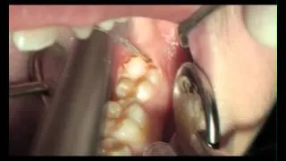 Стоматологические лазеры - иссечение капюшона
