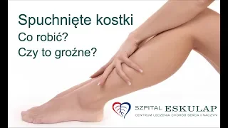 Opuchnięte kostki nóg - jak leczyć i zapobiegać?