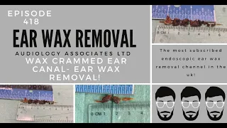 WAX CRAMMED EAR CANAL - EAR WAX REMOVAL - EP418