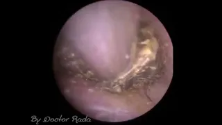 Why Don't You USE The Ear hook  ear wax removal By Doctor Rada