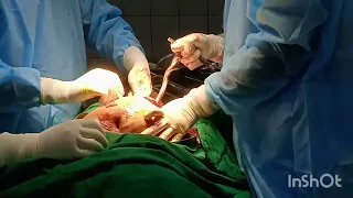 ChildBirth-C Section (Cesarean Delivery)❤️❤️