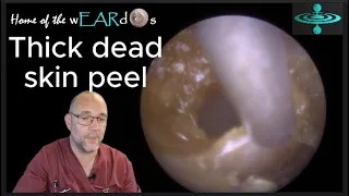 Thick dead skin peel - Ep 128 #ear #earwax #earwaxremoval #earcleaning #earwaxclinic