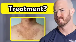 How to Treat Tinea Versicolor | Dr Dustin Portela