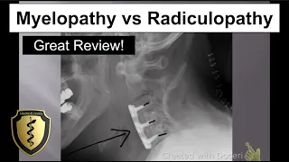 Myelopathy vs Radiculopathy - Great Review!