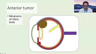 Side Effects of Brachytherapy  (US)