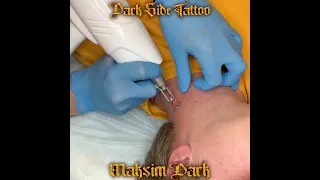 Удаление тату на шее. Тату студия «Dark Side Tattoo» г. Воронеж